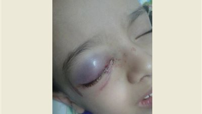 بالصور.. إصابة طفلة في الشرقية بسبب الإهمال المدرسي