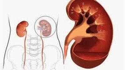أستاذ جراحة بجامعة القاهرة: إيران الدولة الأولى لبيع «الكلى» في العالم