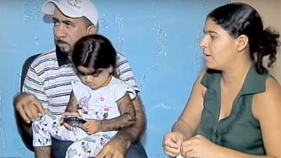 بالصور.. مخاوف والدي «الطفلة الذئب» تزداد بعد توقف علاجها