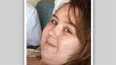 «العريس الندل».. أصيبت بورم في المخ فتركها خطيبها بسبب ازدياد وزنها (صور)