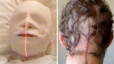 بالصور.. خطأ طبي يحول شابا إلى مومياء