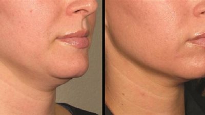 ماسك النشا بالحليب وعصير الخيار لشد ترهلات الرقبة