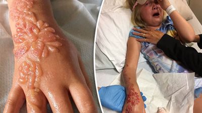 صحيفة بريطانية تزعم: «حنة الغردقة» تتسبب في تشوية ذراع طفلة 7 سنوات