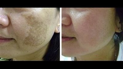 بالفيديو.. وصفة سحرية تخلصك من حروق الشمس