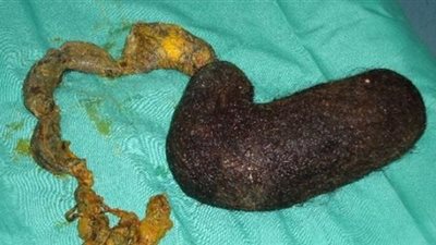 إزالة كتلة شعر وزنها 1300 جرام من بطن فتاة يمنية