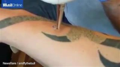 بالفيديو.. طريقة إزالة الوشم بالليزر