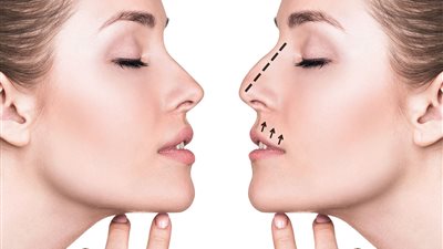 استشاري يوضح أهمية تقنية حقن الفيلر لتجميل الأنف