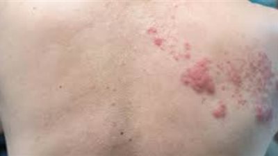 مرض الحزام الناري .. الأسباب والأعراض