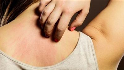 أنواع الحساسية الجلدية وطريقة العلاج