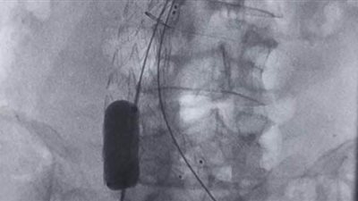 خبير مصري عالمي يجري عملية نادرة بمستشفيات جامعة الزقازيق | صور