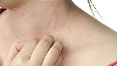 طرق الوقاية من مرض الاكزيما الجلدية وأفضل سبل العلاج