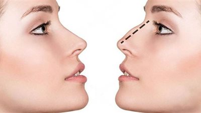 جراحات الأنف التجميلية تجعل النساء يبدين أصغر بنحو 3 سنوات