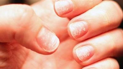 8 أعراض للإصابة بنقص الحديد في الجسم