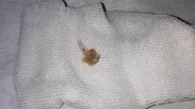 إنقاذ حياة طفل بعد استقرار شوكة سمكة في قصبته الهوائية بمستشفى بنها الجامعي