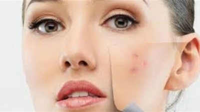 7 نصائح تساعدك في علاج حبوب الوجه والتخلص منها سريعا