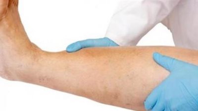 4 أعراض تؤكد الإصابة بجلطة الساق