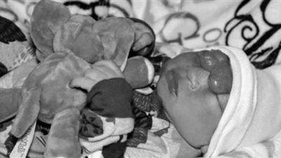 ولادة طفل بمخ خارج الجمجمة | صور