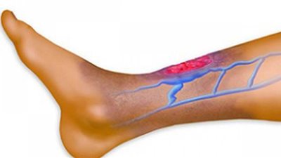 6 أعراض تؤكد إصابتك بجلطة الساق ..احذرها