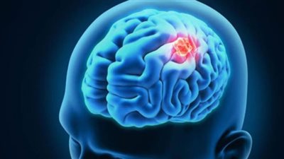 دراسة تكشف علاقة فيروس شلل الأطفال بسرطان الدماغ 