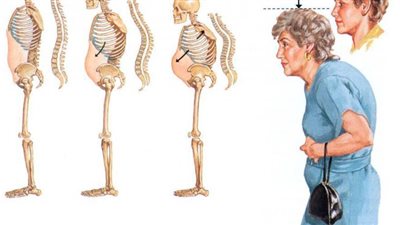 تعرف على أنواع مرض هشاشة العظام.. وطرق الوقاية والعلاج بالغذاء