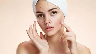 تعرفي على أسباب ظهور حب الشباب وطرق علاجه | فيديو