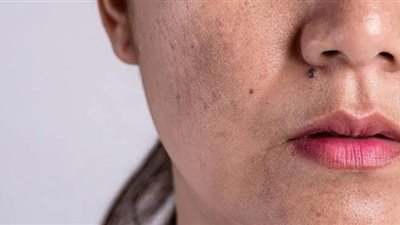 استشاري أمراض جلدية يكشف أسباب التصبغات الجلدية