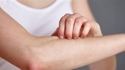 استشاري أمراض جلدية يكشف عن خطوات علاج التينيا