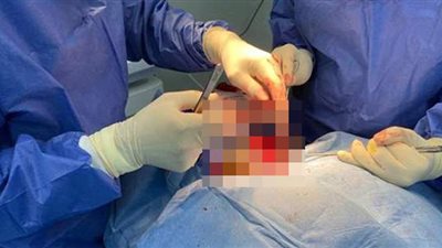 نجاح عملية استئصال ورم بالغدة الدرقية لإحدى منتفعات التأمين الصحي الشامل ببورسعيد