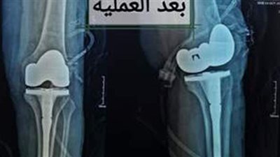نجاح فريق طبي بتغيير مفصل ركبة لمريضة بمستشفى المنصورة العام الجديد