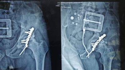 صحة الدقهلية: استبدال مفصل فخذ صناعي كامل لمريض بمستشفى المنصورة