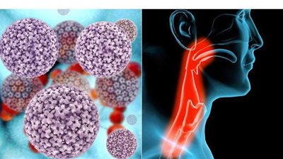 أعراض الإصابة بسرطان الحنجرة وأسبابه وطرق الوقاية