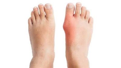 أعراض مرض النقرس..  يصاحبه نوبات مفاجئة من الآلام