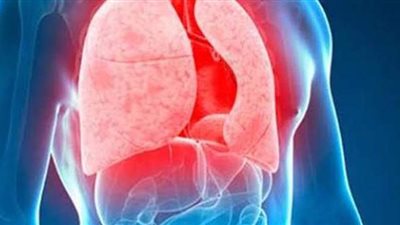 ما هو مرض الدرن.. اعراض مرض الدرن وكيفية الإصابة