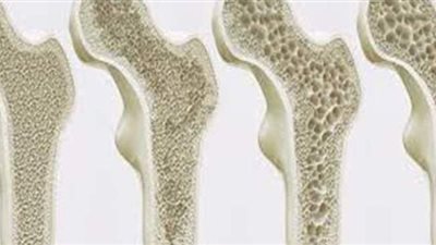 6 نصائح للوقاية من هشاشة العظام