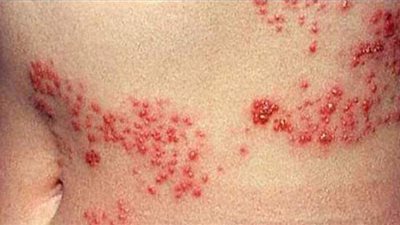 مرض الحزام النارى.. الأعراض والعلاج