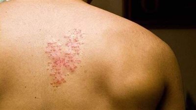 ما هو مرض الحزام النارى