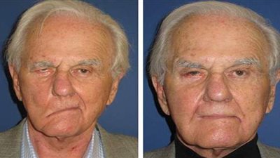 أعراض التهاب العصب السابع وأهم أسبابه وطرق العلاج