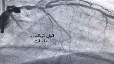 نجاح فريق طبي في تركيب  دعامات دوائية لمريض بمستشفى المنصورة