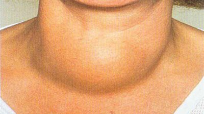 دراسة: سرطان الغدة الدرقية لا يتطلب الجراحة ولا يؤدي إلى الوفاة