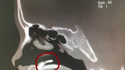 بالصور.. امرأة تكتشف سنا ينمو داخل أنفها