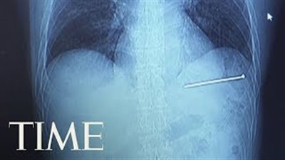 بالفيديو.. شاهد ماذا فعل رجل بعدما اخترق مسمار قلبه