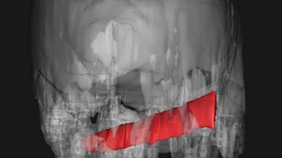 سكين تعلق برأس رجل أربعة أيام قبل التخلص منها (صور)