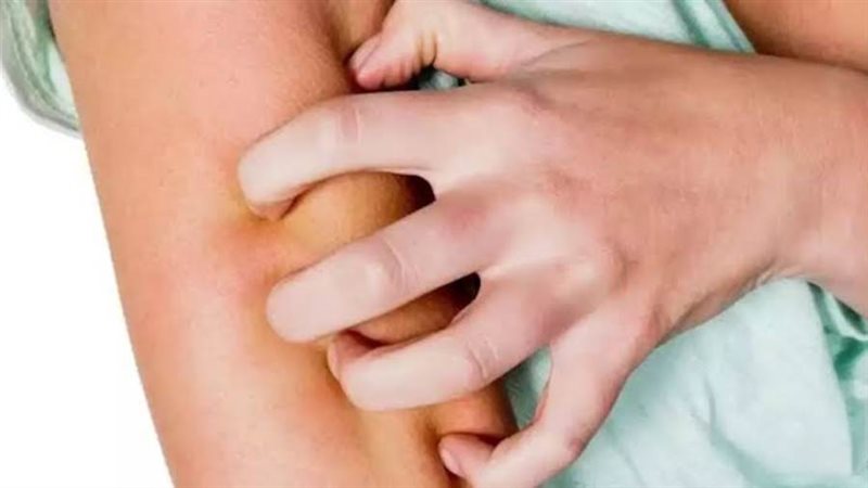 تفشي الجرب في تركيا