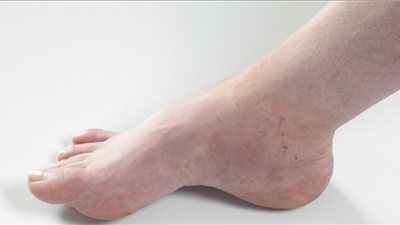 أفضل 8 علاجات منزلية لتجنب الإصابة بالقدم السكري