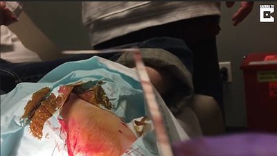 بالفيديو والصور.. لحظة إخراج طبيب إبرة طويلة من قدم صبي