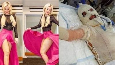 بالصور.. فتاة تتعرض لحادث مأساوي بسبب «الغيرة»