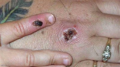 الإعلان عن ثالث إصابة بـ«جدري القرود» في بريطانيا