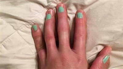 شاهد.. تصرف رجل مع زوجته فقدت إصبعها يشعل «فيس بوك»