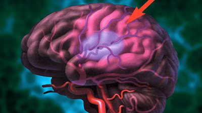 طبيب ألمانى يحدد الجزء المسئول عن الشر وارتكاب الجرائم فى المخ