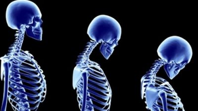 دراسة: العظام تتعرض للبدانة!